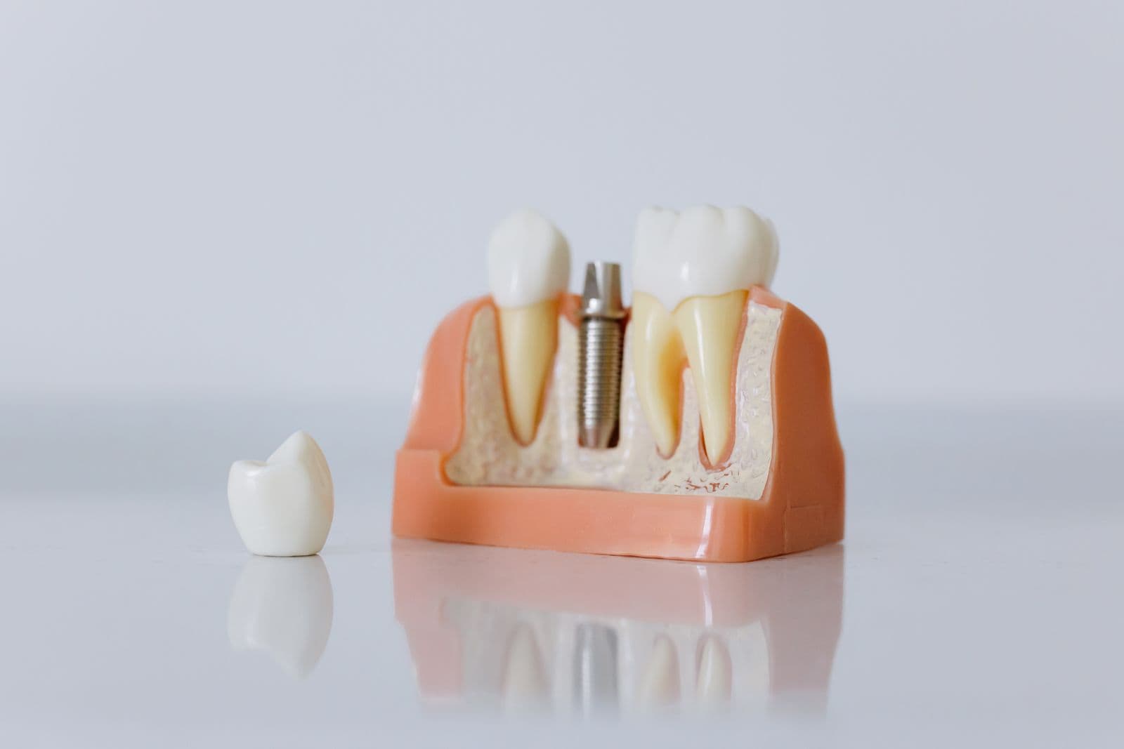 Modelo odontológico com um implante entre dentes