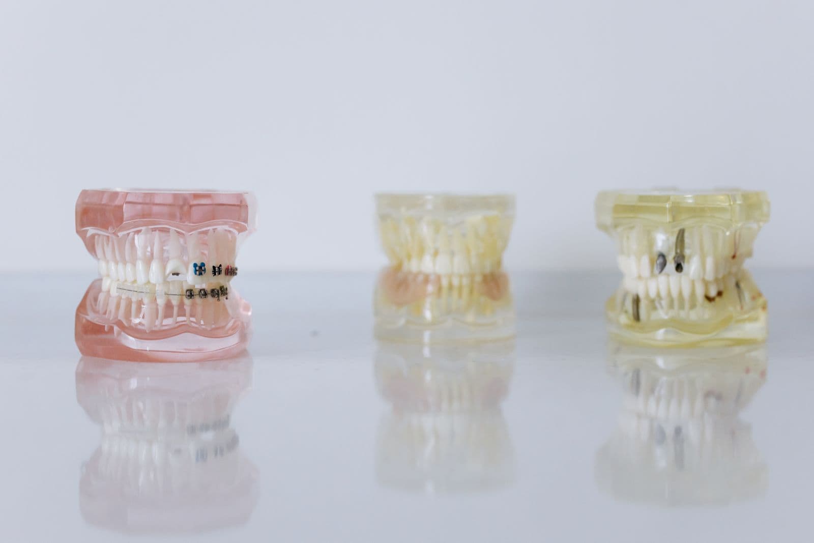 Modelos odontológicos, um deles com aparelho ortodôntico